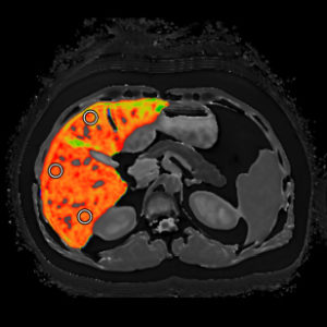 Picture of advanced imaging of the liver