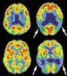 PET of the brain showing Alzheimer indications