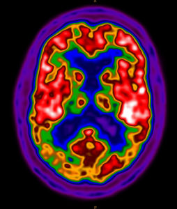 Picture of a brain using PET/CT